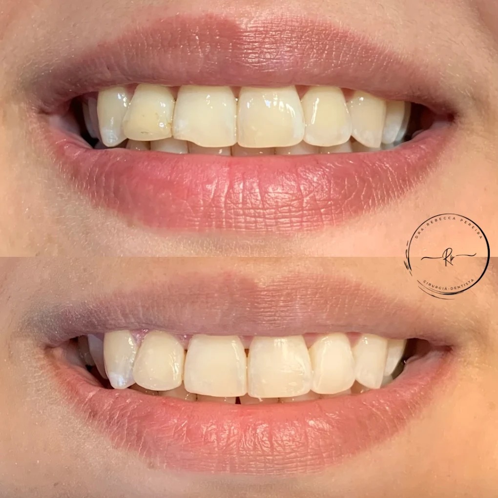 Clareamento Dental