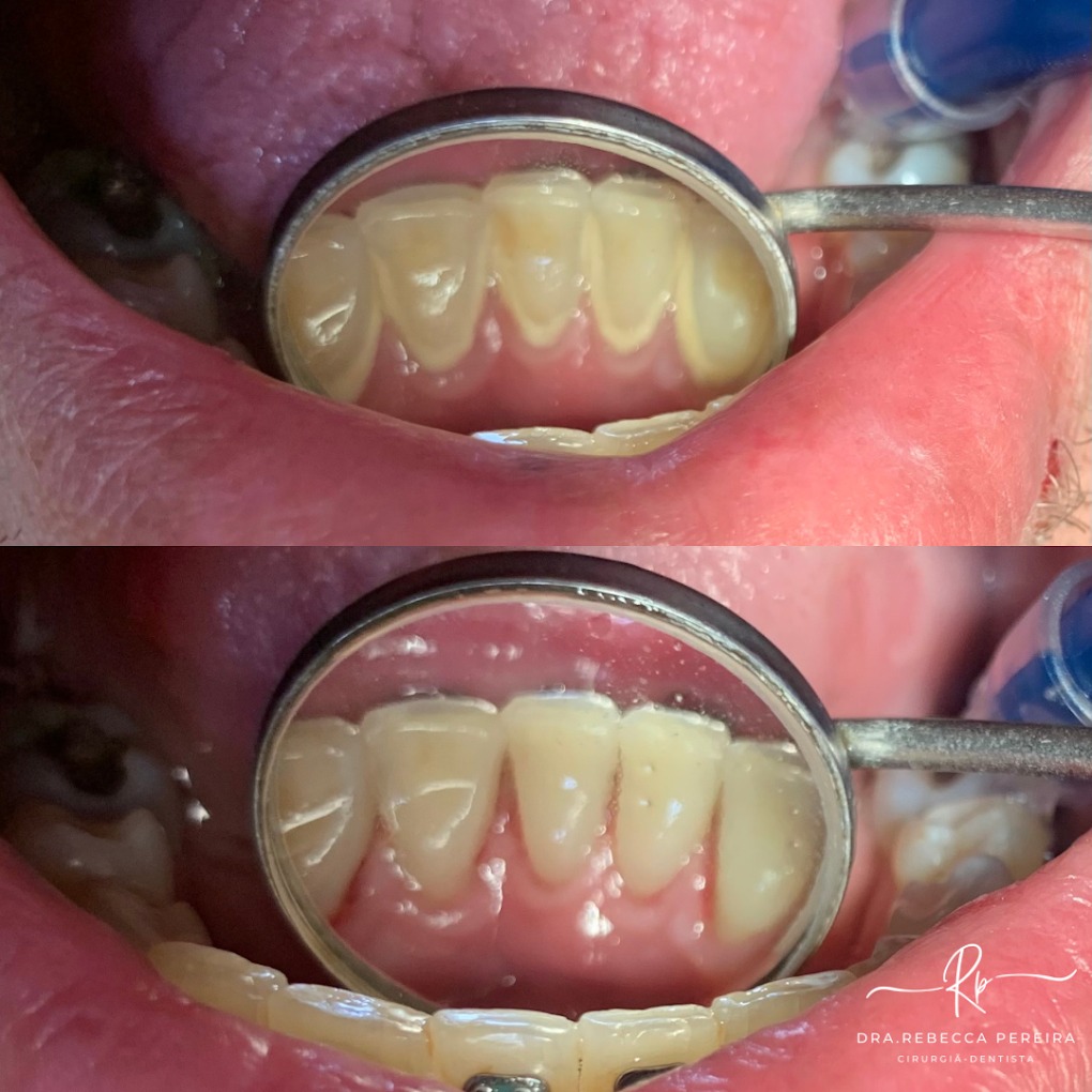 Limpeza Dental